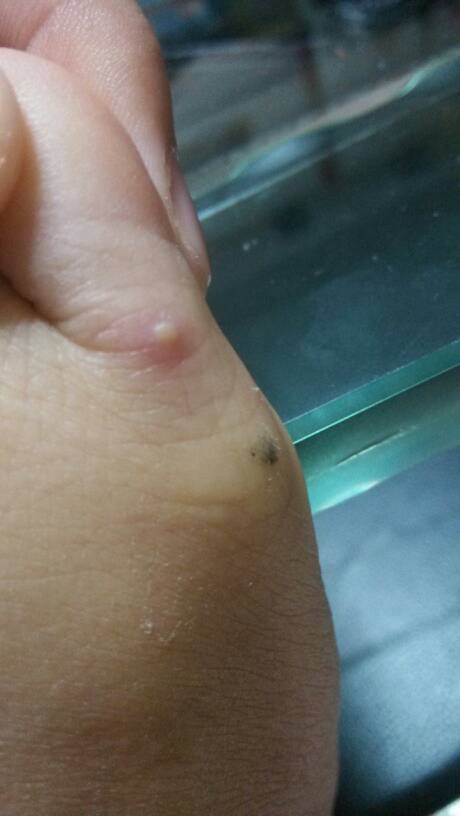 脚上起小水泡还很痒是什么原因(脚上起小水泡很痒是怎么回事百度百科) 脚上起小水泡还很痒是什么原因(脚上起小水泡很痒是怎么回事百度百科)